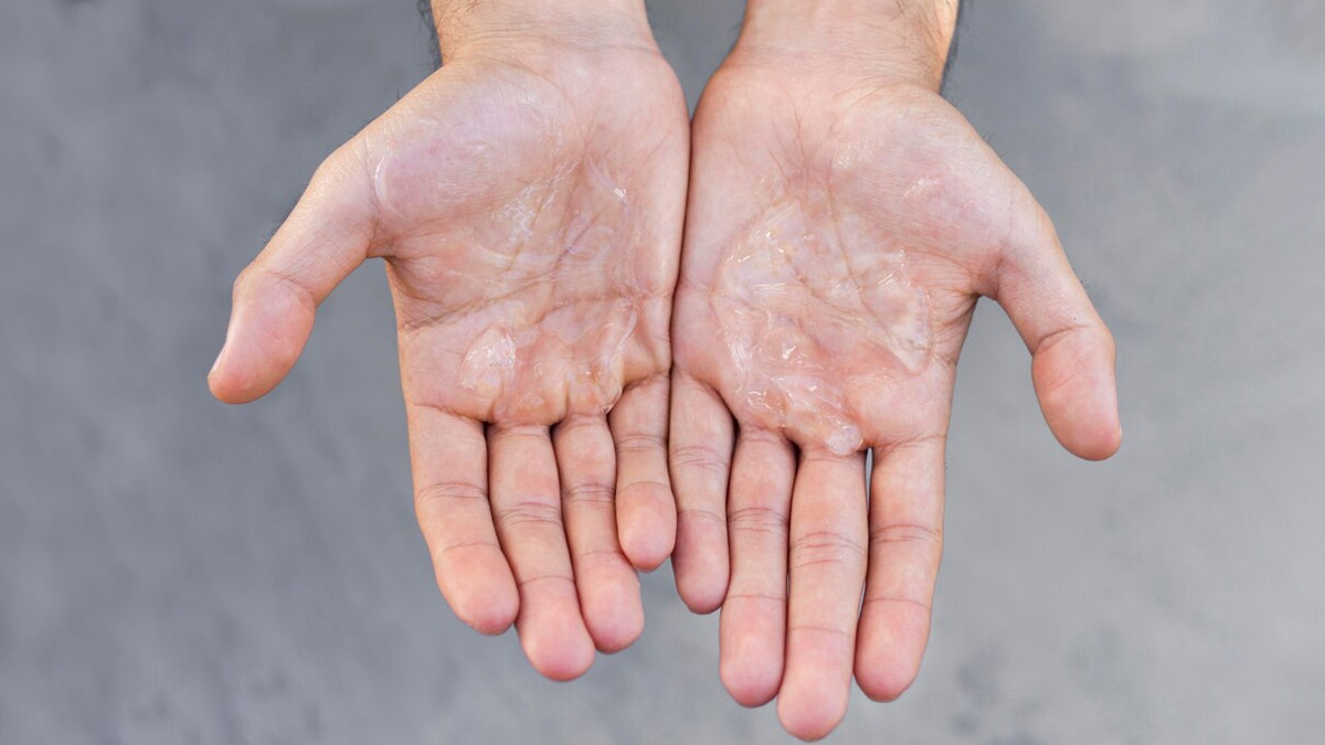 Palmar Hyperhidrosis